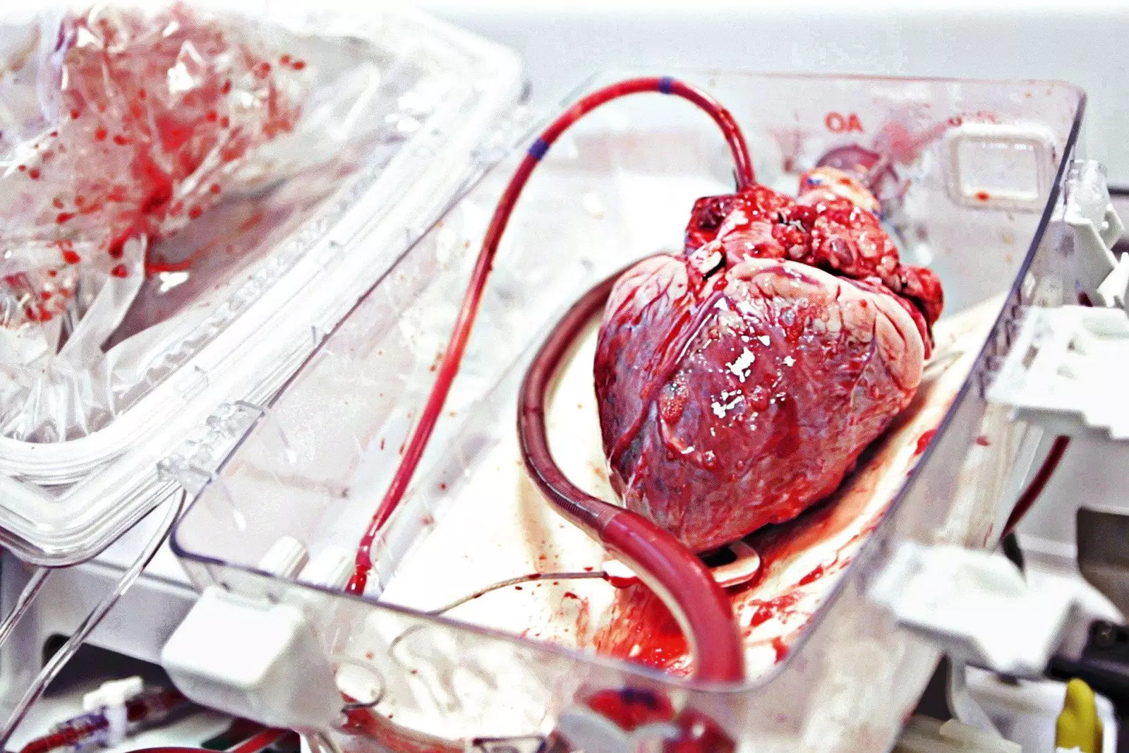 A heart donated for heart transplants