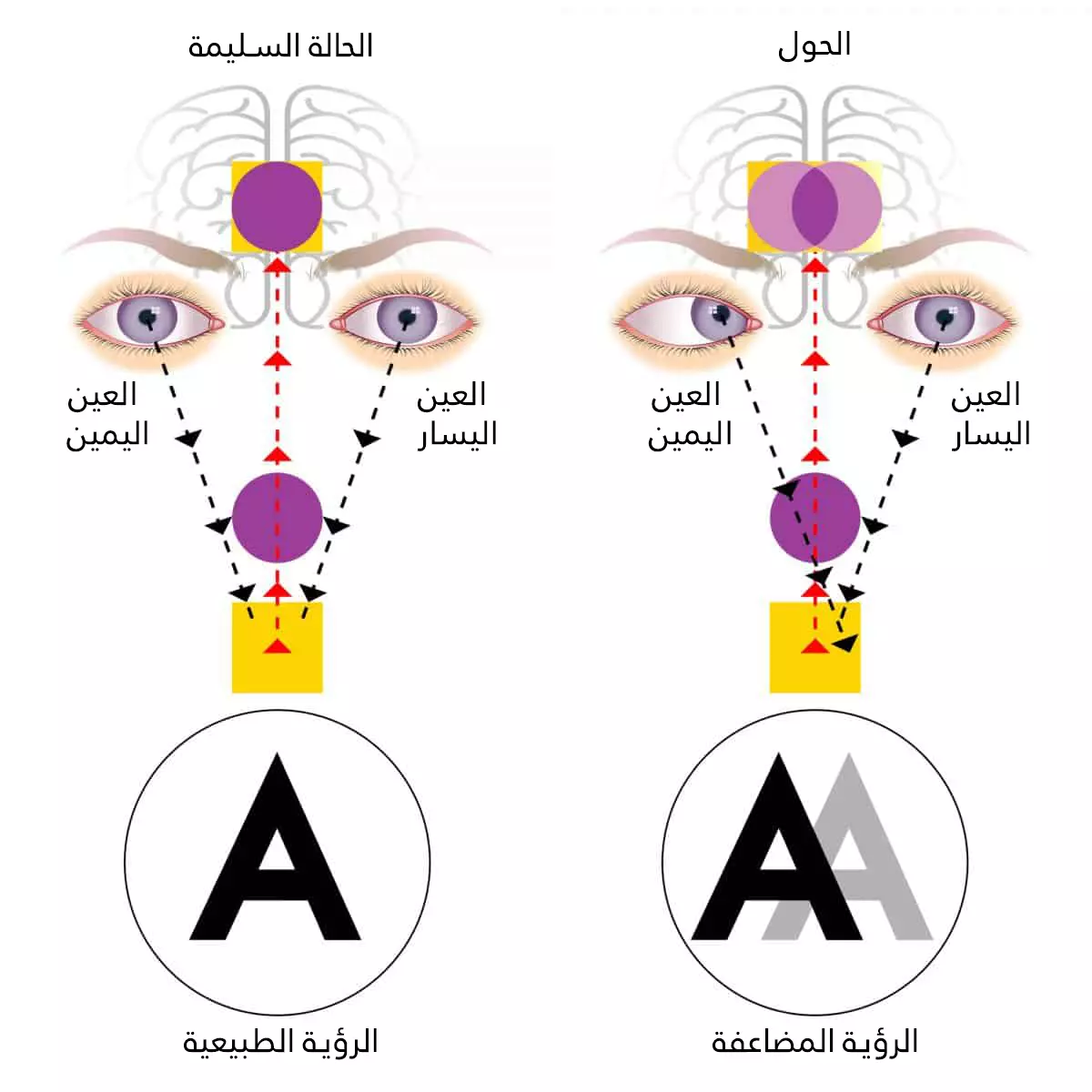 In a normal machine, the eyes focus on the same point, but in strabismus, the eyes focus on two different points