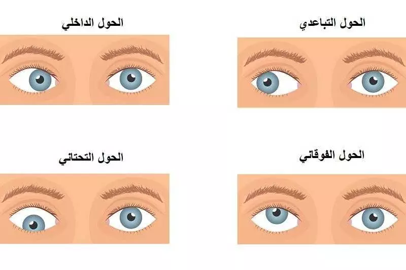 Şaşılık, sapmış gözün yönüne göre dört tipe ayrılır.