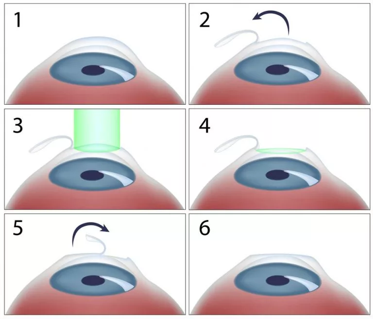 Through this technique, the surface layer of the cornea is removed and then the laser vision is corrected and the surface layer is returned to its place