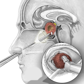 The pituitary tumor was removed using an endoscope equipped with surgical instruments