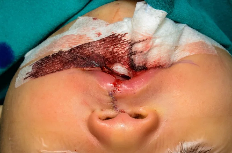 شكل الشفة الأرنبية بعد إجراء جراحة الشفة الأرنبية في تركيا