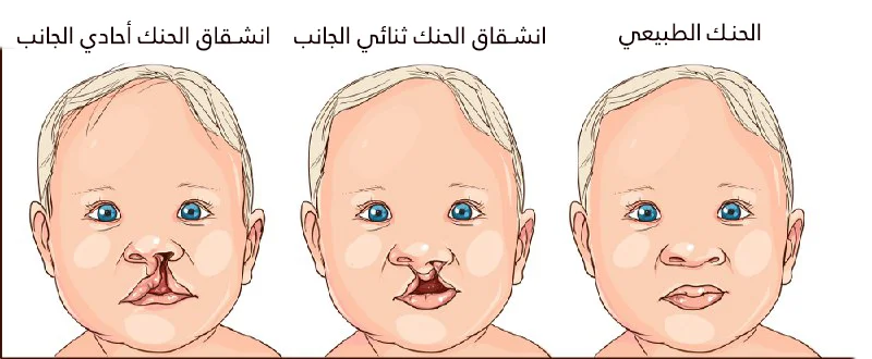 The cleft lip may be unilateral or bilateral