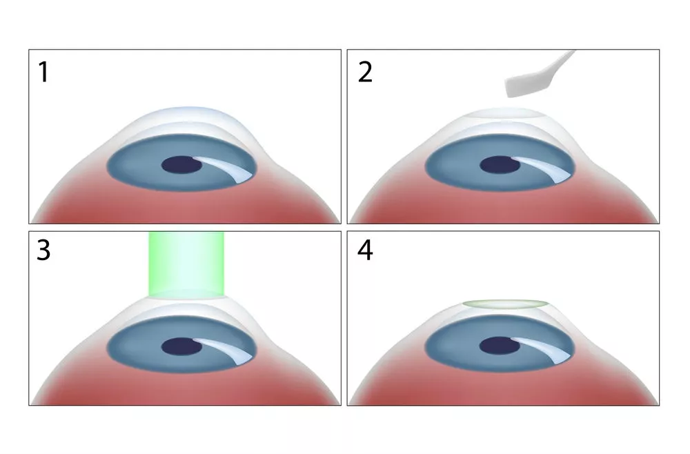 Through this technique, a thin layer of the corneal surface is removed by laser