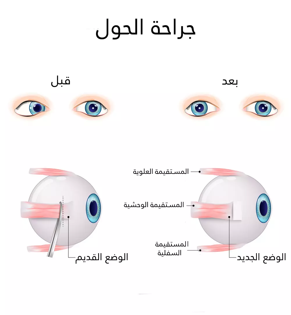 The lateral rectus muscle was shortened to correct strabismus