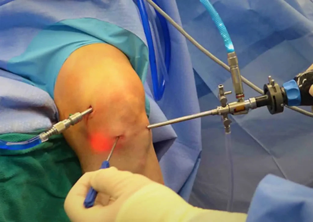 During knee arthroscopy