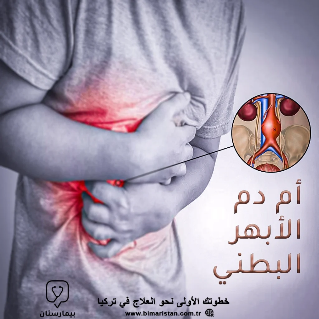 Abdominal aort anevrizması ve Türkiye'de tedavisi