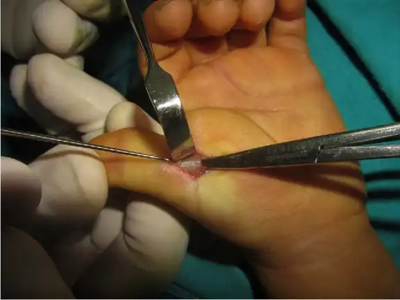 Surgical treatment of trigger finger