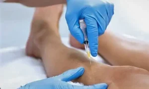 Sclerotherapy by injecting the solution into the affected vein