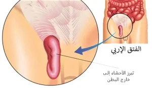 الفتق الإربي وتبرز الأحشاء إلى خارج البطن