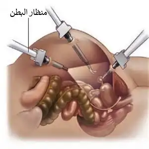 laparoskopi