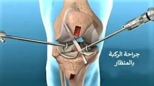 تنظير مفصل الركبة