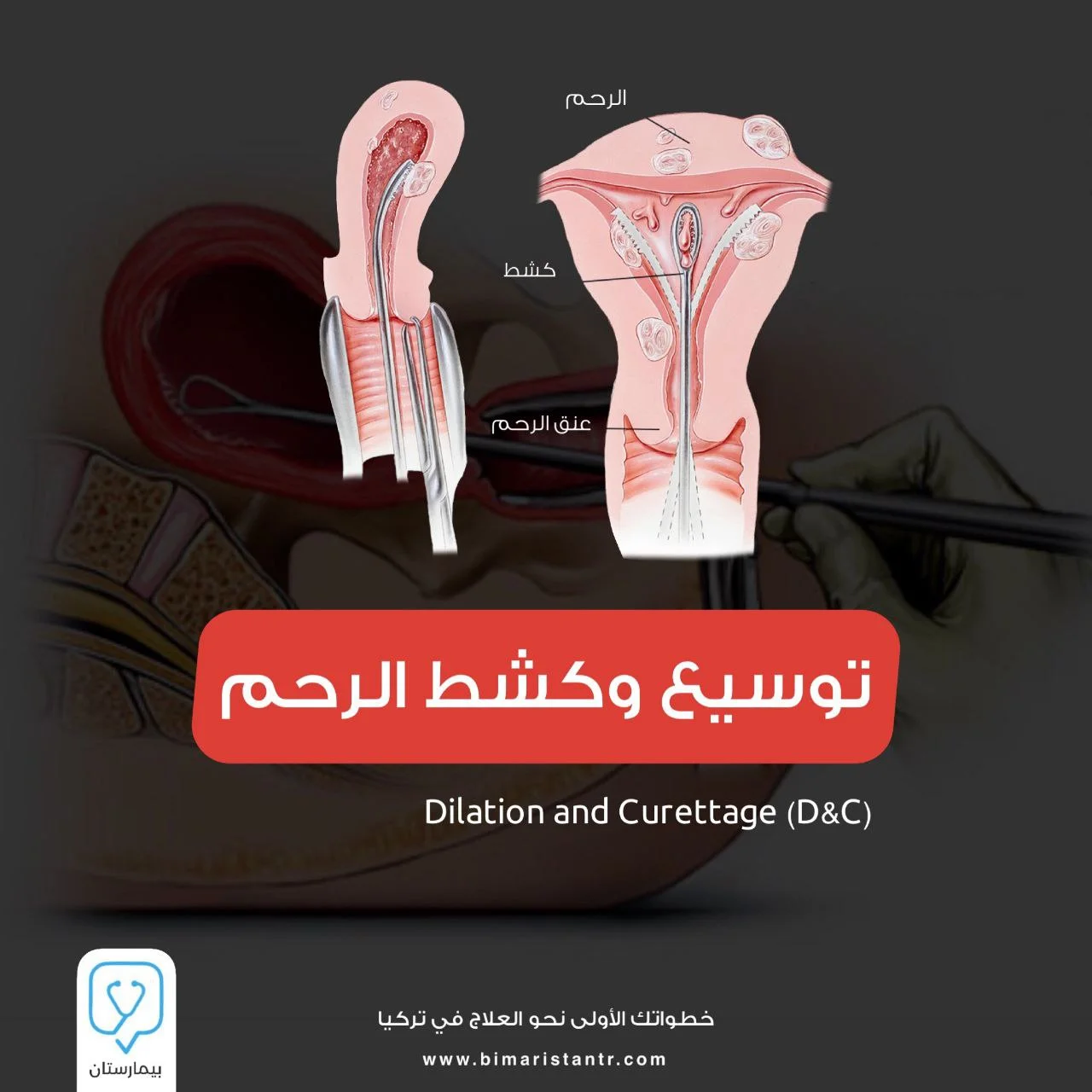 Dilatation and curettage of the uterus