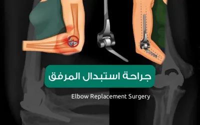 Elbow joint replacement surgery