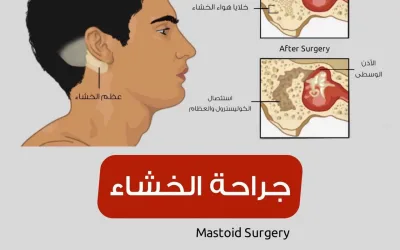 Mastoidectomy - mastoiditis and its symptoms
