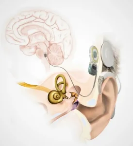 جهاز جذع الدماغ السمعي