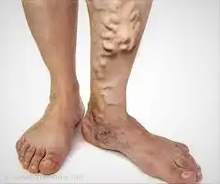severe varicose veins