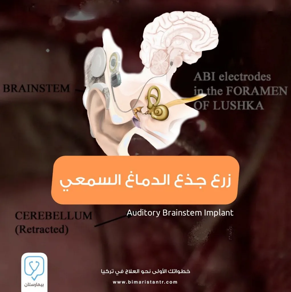 علاج الصمم: عملية زرع جذع الدماغ السمعي في تركيا