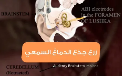 عملية زرع جذع الدماغ السمعي- علاج الصمم