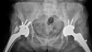 X-ray after the operation