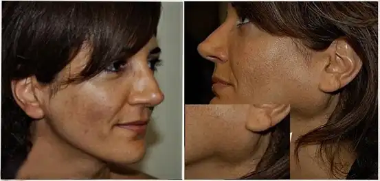 Photo before and after treatment
