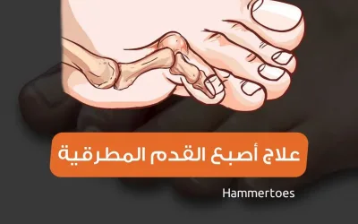 Hammer toe treatment