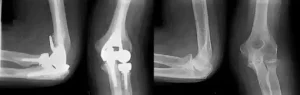 Before and after elbow joint replacement surgery