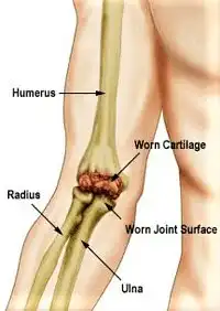A joint that needs elbow replacement surgery