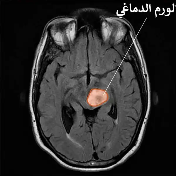 صورة رنين مغنطيسي لسرطان في الدماغ