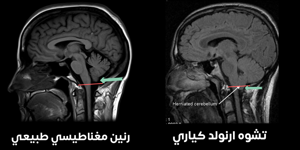 Arnold-Chiari sendromu bağlamında beyinciğin foramen magnum yoluyla fıtıklaşmasını gösteren manyetik rezonans görüntüleme (MRI)
