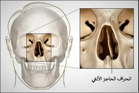 The nasal septum deviates from the midline