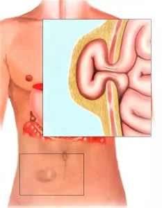 صورة توضح الفتق البطني