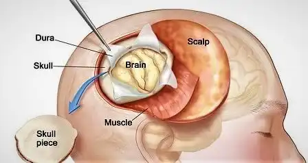 Beyin tümörlerinin eksizyonu sırasında üst tabakalar çıkarılarak ameliyatın gerçekleştirilme yöntemi