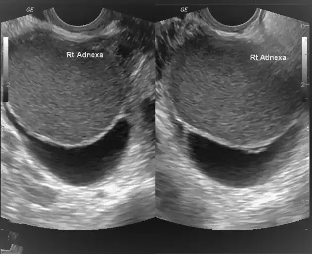 Ultrasound diagnosis of endometriosis