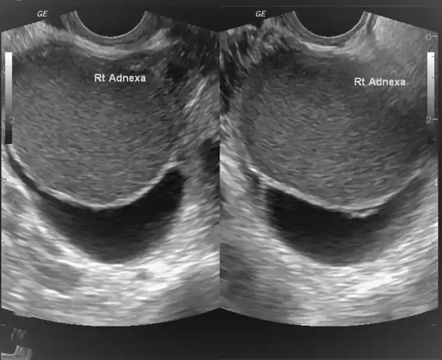 تشخيص بطانة الرحم المهاجرة بالسونار