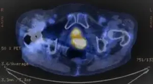 Eksenel pozitron emisyon tomografisi