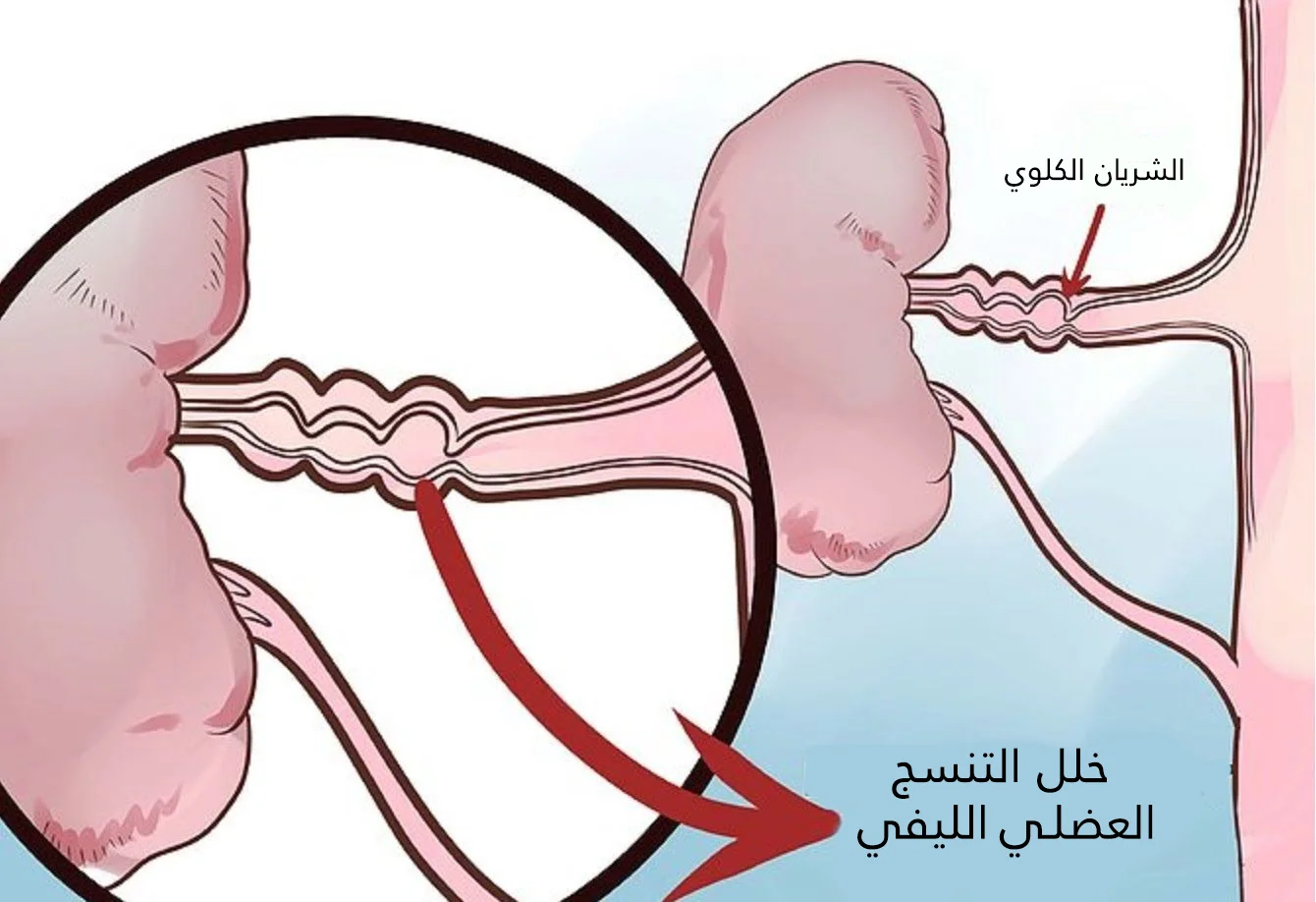 Fibromüsküler displazi arteriyel lümen bozulmasına ve renal arter darlığına yol açar