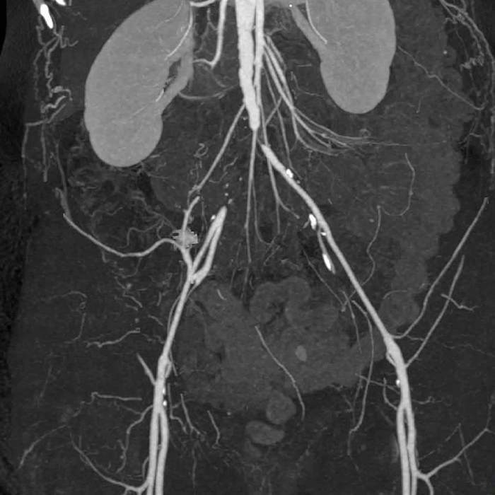 Diagnosis of Lerich syndrome and detection of interruption in the blood flow at the end of the aorta and the beginning of the right iliac artery by angiography in Turkey