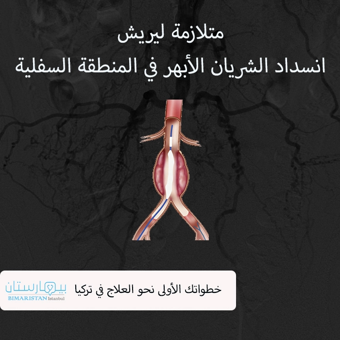 Lerich sendromu - Türkiye'de alt aort tıkanıklığının tedavisi