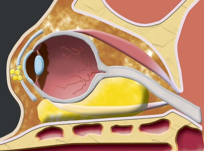 Lymphangioma may be localized in the eye socket and cause compressive visual symptoms
