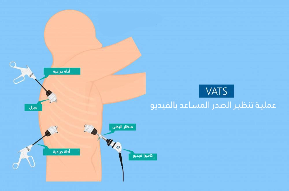 يتم إجراء عملية تنظير الصدر عبر ثلاث ثقوب صغيرة في صدر المريض يتم من خلالها إدخال الأدوات الجراحية بالإضافة إلى منظار مزود بكاميرا