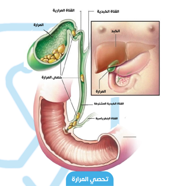 Gallstones form in the gallbladder and then accumulate in the bile ducts and block it
