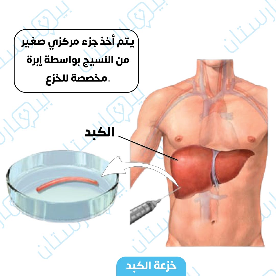 تظهر عملية أخذ الخزعة الكبدية في هذه الصورة بواسطة إبرة خازعة خاصة