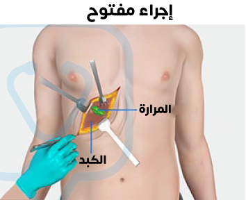 لاحظ الشق الجراحي الكبير في عملية استئصال المرارة بالجراحة المفتوحة