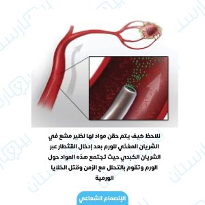 الإنصمام الشعاعي