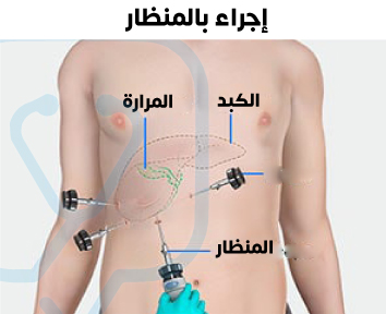 Laparoscopic (laparoscopic) gallbladder surgery