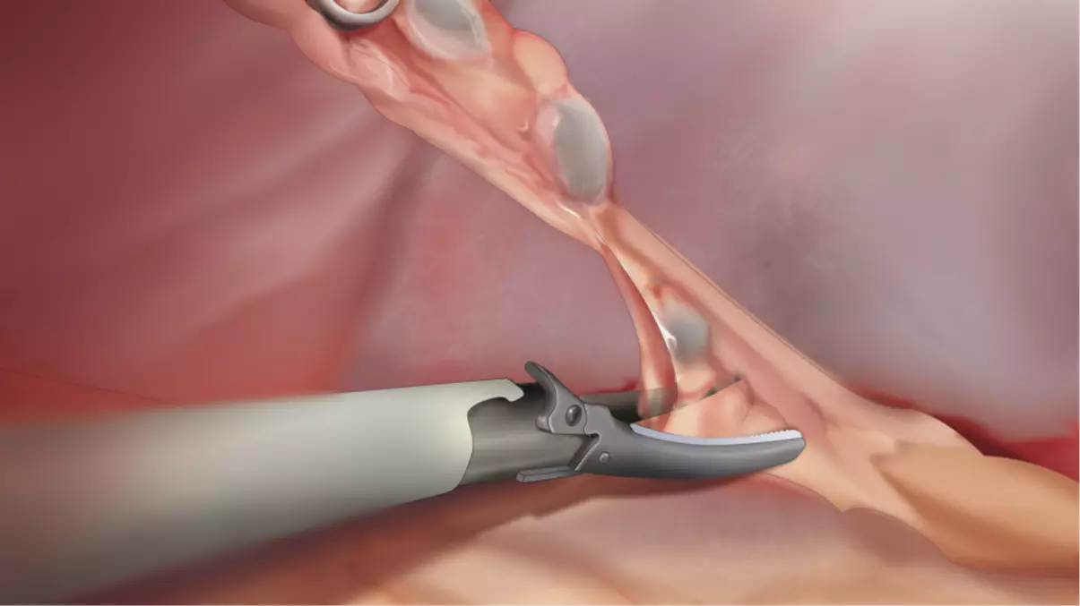 Endoscopic removal of lymph nodes