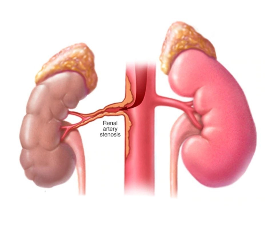 What is renal artery stenosis?