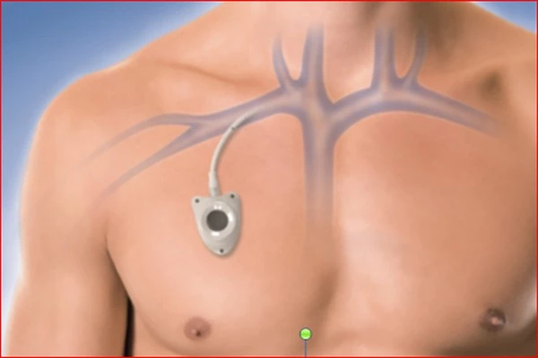 The central venous catheter in Turkey is usually placed in the right subclavian vein and the portal catheter is implanted under the skin of the chest