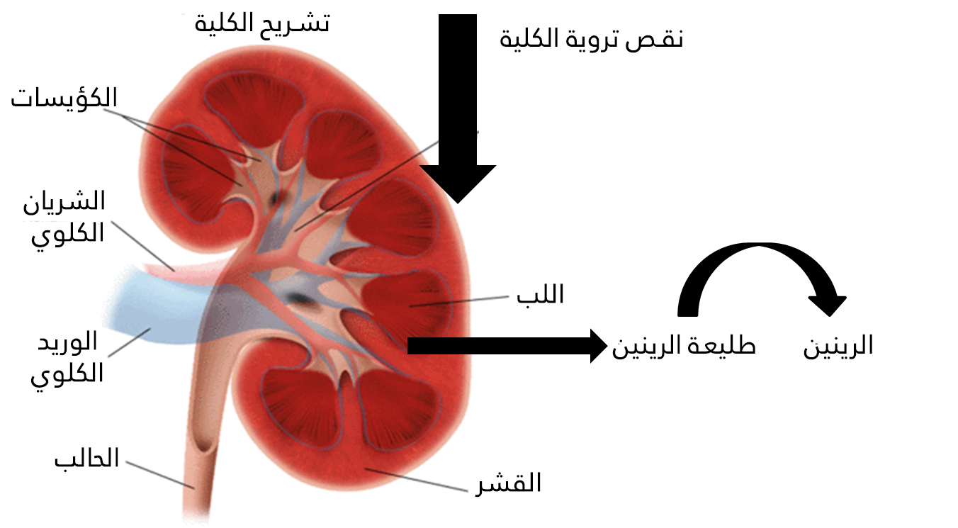 Mechanism of high pressure in renal artery stenosis